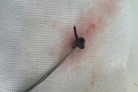 Ngạt mũi cả tuần, đi khám phát hiện vắt dài 3 cm trong hốc mũi