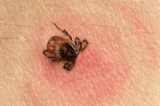 Bác sĩ cảnh báo nguy cơ tử vong do chẩn đoán muộn sốt mò