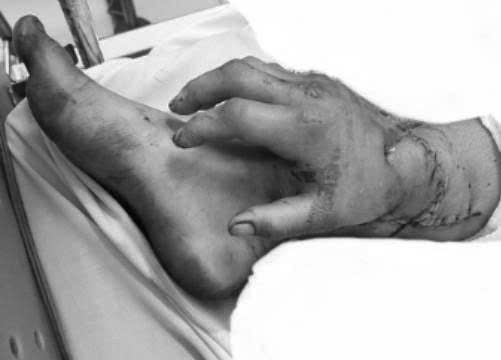 Ghép tạm tay đứt lìa vào chân để bảo toàn cho  sản phụ bị tai nạn lao động mang song thai