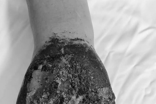 Nhiễm trùng nặng sau khi chữa vết thương bằng lá cây