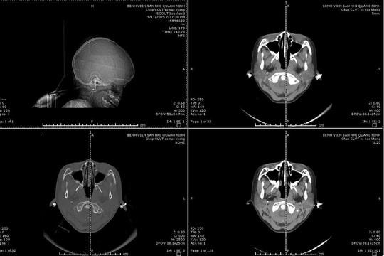 Kích hoạt "báo động đỏ" cứu sống bệnh nhi vỡ sọ phức tạp