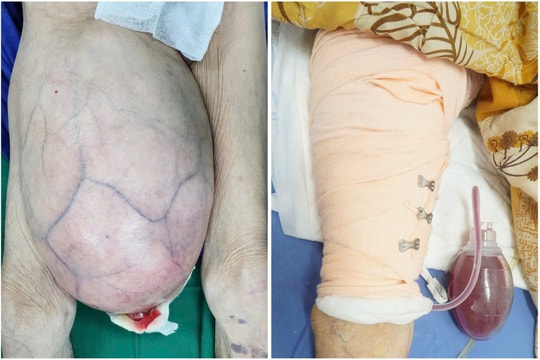 4 giờ phẫu thuật, bóc tách khối u 8,2kg khỏi đùi bệnh nhân