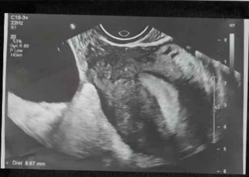 Chủ quan với cơn đau bụng bất thường, người phụ nữ suýt mất khả năng làm mẹ