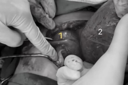 Phẫu thuật thành công ca chuyển dạ cho sản phụ có tử cung đôi