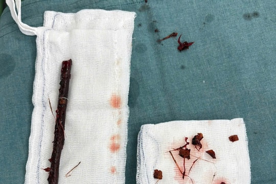 Hy hữu: Suốt 4 tháng, bé gái 3 tuổi mang cành cây dài 16cm trong bụng