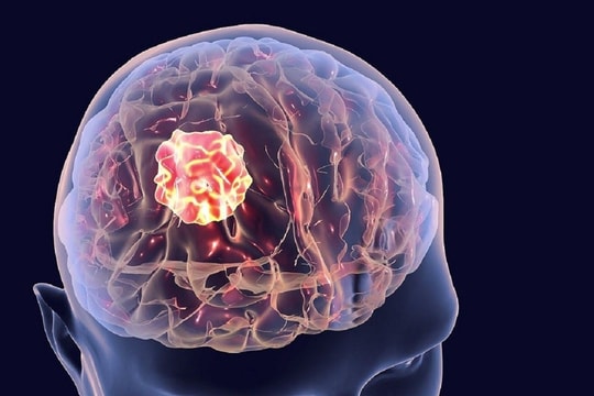 Dấu hiệu nhận biết ung thư di căn não