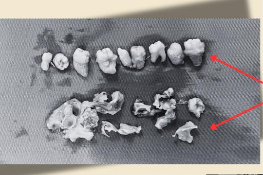 Bệnh nhân nữ 21 tuổi suýt mất khả năng làm mẹ do khối u quái có chứa xương, răng và tóc