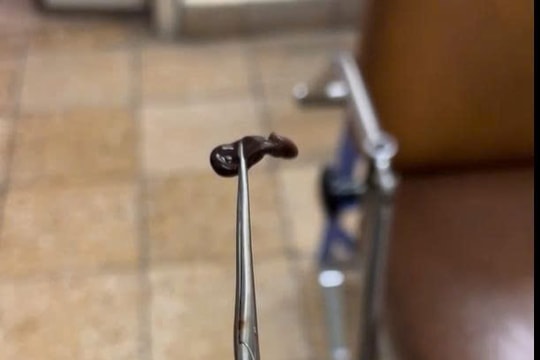 Chảy máu cam kéo dài, bé trai nhập viện vì vắt trú ngụ trong mũi