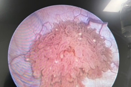 Không triệu chứng, cô gái 26 tuổi ngỡ ngàng khi phát hiện u bàng quang