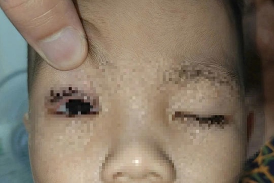 Bé trai 2 tuổi nhập viện vì bỏng mắt do pháo hoa Trung thu