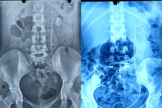 Nữ bệnh nhân bị bỏ quên thiết bị y tế trong cơ thể suốt 15 năm