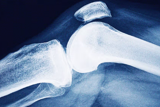 Để ngừa loãng xương, vì sao bác sĩ khuyên bạn bỏ hút thuốc lá?