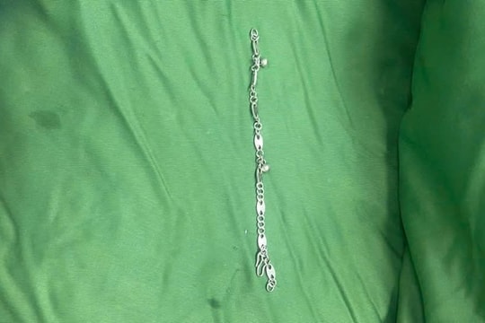 Cấp cứu kịp thời bé gái 5 tuổi nuốt vòng tay bạc dài 7cm