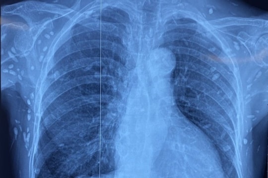 Rối loạn ý thức, người phụ nữ được chẩn đoán nhiễm ấu trùng sán dây lợn