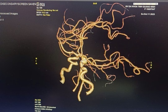 Tự ý dùng thuốc khi đau đầu, người phụ nữ suýt mất mạng