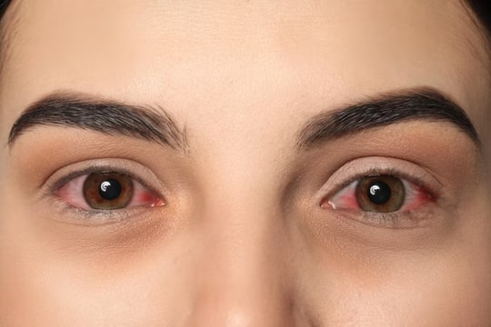 Cẩn trọng bệnh đau mắt đỏ bùng phát sau mùa mưa bão