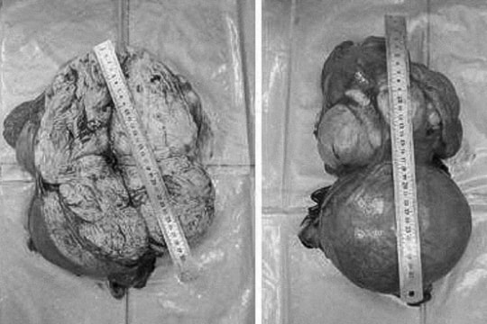 Tưởng lầm mang song thai, người phụ nữ phát hiện khối u tử cung khổng lồ 8kg