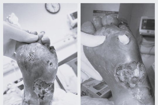 Bệnh nhân đái tháo đường nặng thoát nguy cơ cắt cụt chi