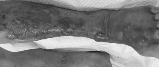 Nguy cơ nhiễm khuẩn "ăn thịt người" từ hải sản sống và nước biển