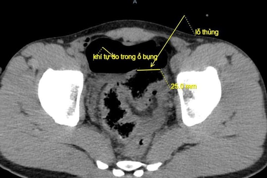 Hy hữu: Trêu đùa bằng vòi xịt rửa xe gây thủng đại tràng