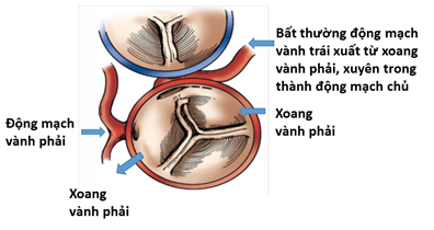 Chạy thể dục buổi sáng, bé gái 11 tuổi bất ngờ bị sốc tim