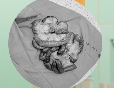 Phẫu thuật cắt 5 mét ruột non cứu bệnh nhân tắc động mạch hiếm gặp