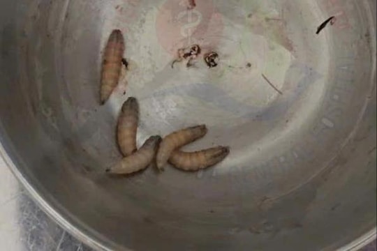 Gắp 5 con giòi sống làm tổ trong tai người phụ nữ