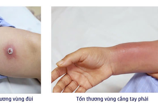 Tưởng giảm đau xương khớp, ai ngờ phải nhập viện vì nhiễm trùng nặng