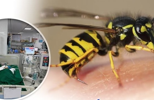 Cứu sống bé gái 9 tuổi bị ong vò vẽ đốt hơn 50 nốt, suy đa tạng nguy kịch