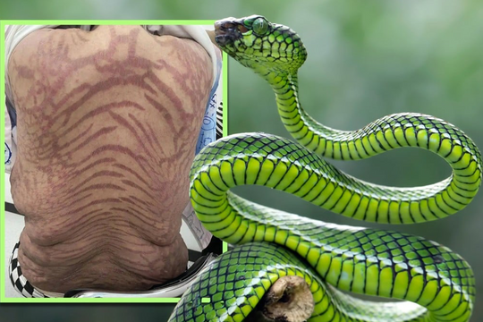 “Sốc” với làn da rắn của người phụ nữ sau 10 năm bôi thuốc “thuần Đông y”