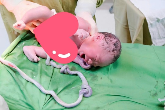 Bé trai 3,3kg chào đời an toàn dù dây rốn thắt hai nút hiếm gặp