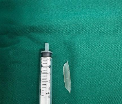 Gắp dị vật xuyên thủng thực quản, cứu sống bệnh nhân trong gang tấc