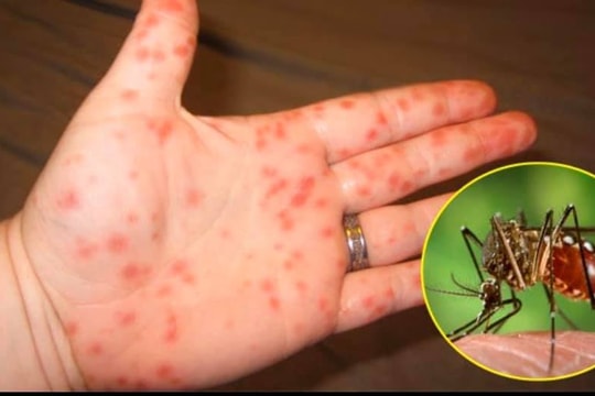 Hà Nội: Số ca mắc sốt xuất huyết mới gia tăng trong tuần