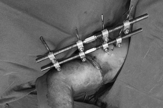 Cứu sống cánh tay bị đứt rời sau tai nạn lao động trong "thời gian vàng"