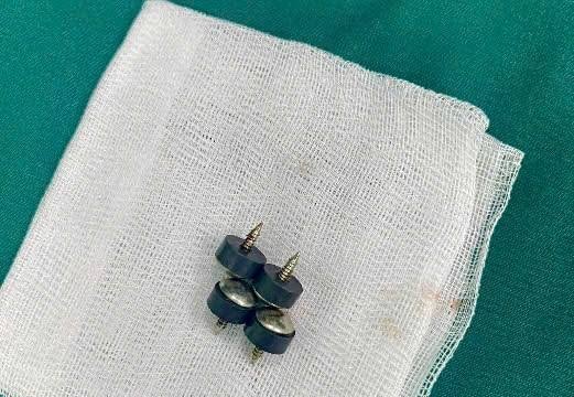 Cấp cứu bé 2 tuổi nuốt 4 viên đinh nam châm nguy cơ thủng ruột