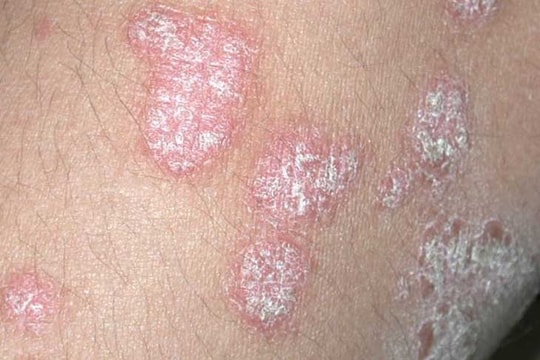 7 cách giảm triệu chứng vảy nến hiệu quả trong mùa đông