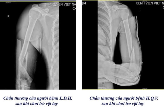 Cảnh báo nguy cơ gãy xương từ trò vật tay
