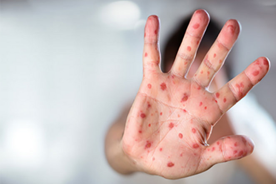 WHO cảnh báo: Căn bệnh không có thuốc chữa đang lây lan nhanh trở lại