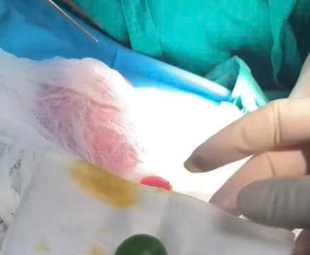 Cấp cứu bé 13 tháng tuổi bị tắc ruột do hạt nở phình to