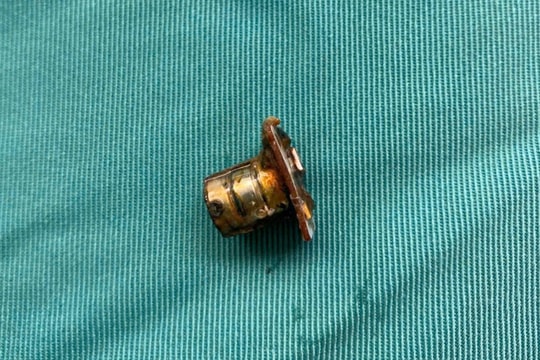 Cấp cứu kịp thời bé trai 2 tuổi nuốt pin cúc áo