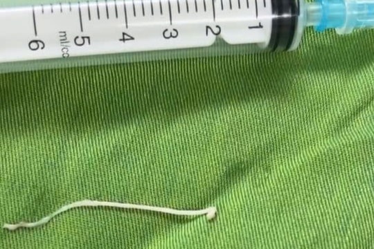 Bất ngờ phát hiện ký sinh trùng trong khối u ổ bụng