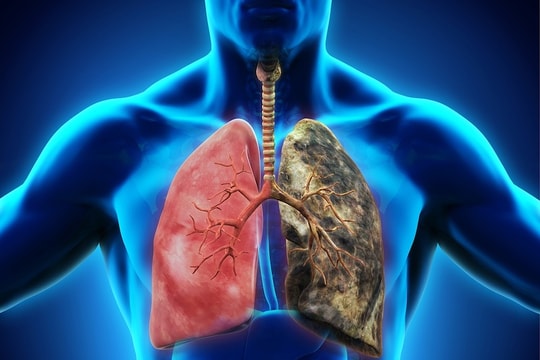 Ung thư phổi: Từ phát hiện bệnh đến lựa chọn điều trị