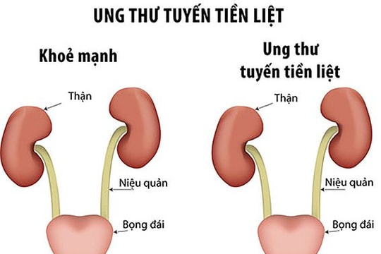 Ung thư tuyến tiền liệt gia tăng, nhiều ca phát hiện ở giai đoạn muộn