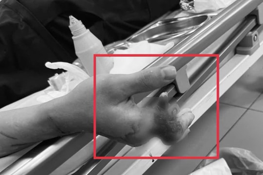 12 giờ phẫu thuật dưới kính hiển vi cứu bàn tay bị đứt 4 ngón
