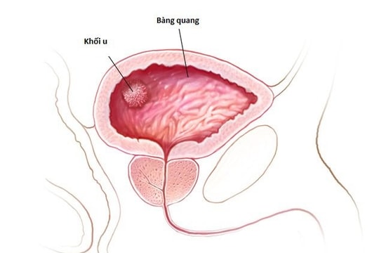 Hút thuốc lá gây nguy cơ hàng đầu ung thư bàng quang