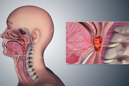 Những dấu hiệu cảnh báo ung thư vòm họng