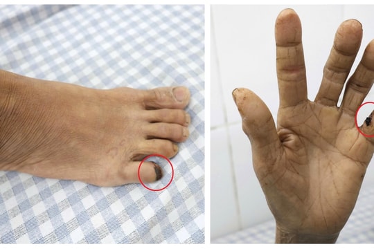 Nhập viện vì vết thương tay do gà đạp vào tay