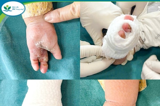 Bé 8 tháng tuổi bị máy tuốt lúa cuốn bàn tay trái