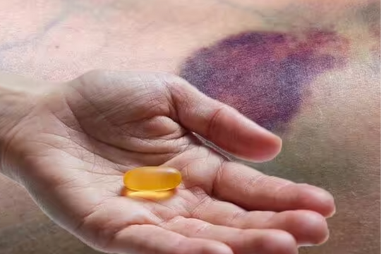 Dễ bị bầm tím, vì bạn đang thiếu một loại vitamin