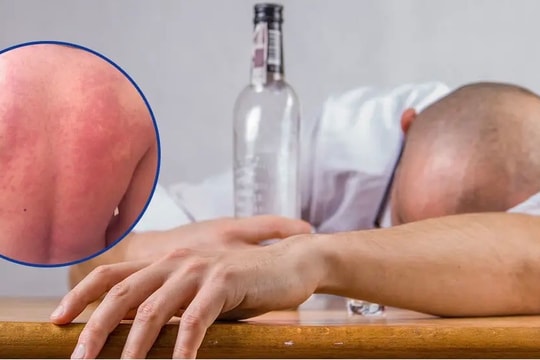 Không chủ quan khi uống rượu bia ngày tết với tình trạng “mẩn ngứa, nóng bừng”